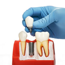 How Long Does It Take to Heal After a Dental Implant?