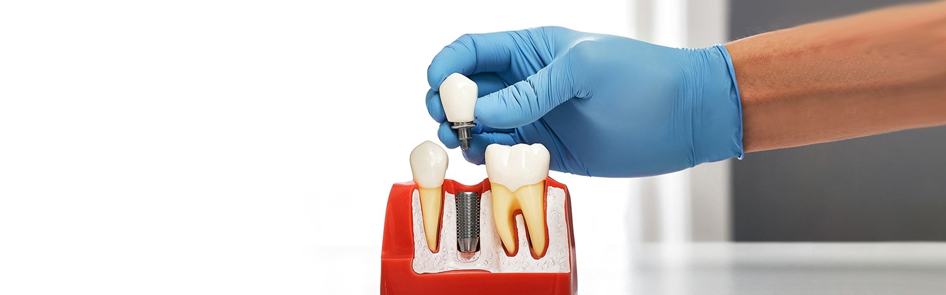How Long Does It Take to Heal After a Dental Implant?