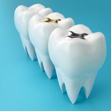 What to Expect During a Tooth Filling Procedure: Step-by-Step Guide
